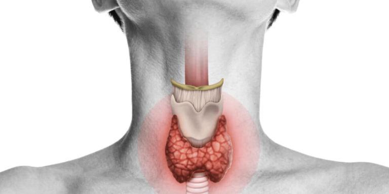 Hashimotos’ thyroiditis: Epidemiology, pathogenesis, clinic and therapy